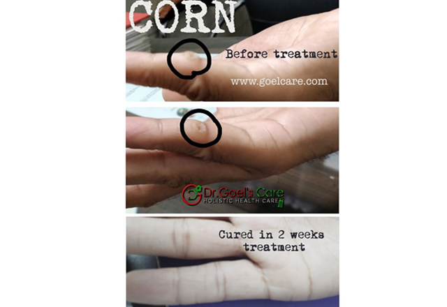 CORN – Very common skin disease