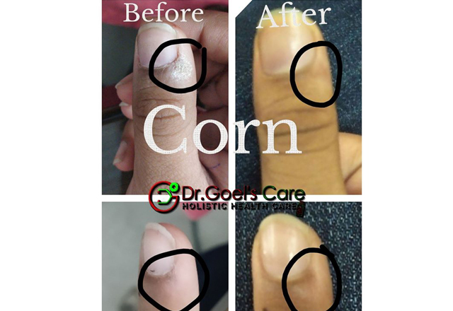 Corn-Inappropriate pencil/pen holding technique.