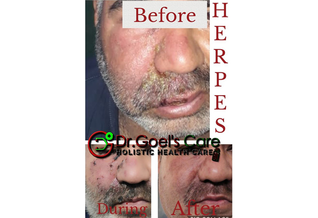 Facial Herpes