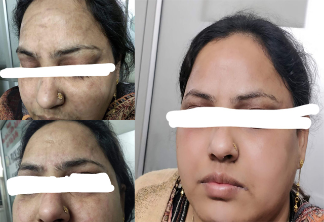 Case of Facial Ringworm
