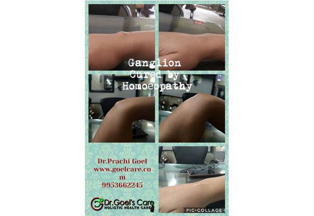 Ganglion cure by Homoeopathy.