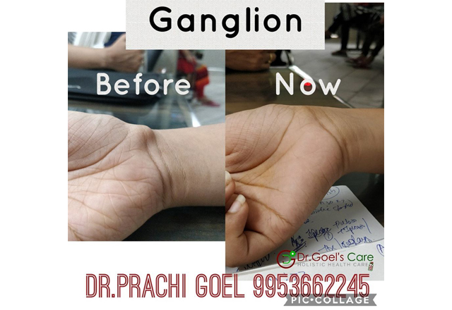 Ganglion