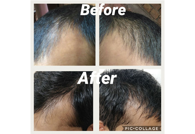 Hairfall Homoeopathy