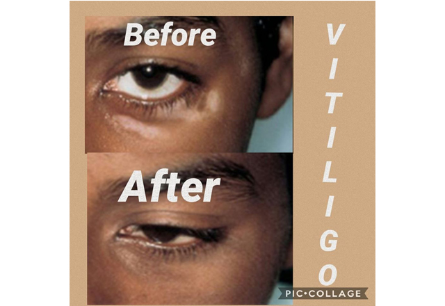 Vitiligo